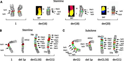 Figure 2. Partial karyotypes of 2 patients demonstrating additional CNAs originating from JT1q12 to16q11. Note: Normal chromosome 16 is not shown for these 2 patients. FISH probes 1q12 (red), 1q21 (green), and 16q11 (aqua) and SKY classification colors for chromosome 16 (light orange) are 1q (yellow), 18 (auburn) and 20 (blue) are shown. (A) The karyotype of patient 17 showed a total of 5 copies of JT1q12, including extra copies on a der(1;16), a der(18), and a der(20). The JT1q12 on the der(18) also demonstrated an extra copy of 16q11(aqua signal) was amplified and translocated from the der(16). (B) The stemline of patient 59 showed 1 normal chromosome 1 (left), a chromosome 1 with a 1p deletion (second from left), a chromosome 16 with the coamplification of 1q12∼23 and 16q11 (third from left), and a coamplified segment of 16q11 and 1q12∼23 translocated to 11p (right). The CN was 8 for both 1q21 and for 16q11 in this clone. (C) In a specimen analyzed 6 months later, a subclone emerged showing a coamplified segment of 16q11 and 1q12∼23 had translocated to the normal chromosome 1q at 1q25 (left) and a second smaller segment of 16q11 and JT1q12 to the other chromosome 1 with deletion of 1p. Note: In this subclone, the CN for 1q21 increased from 8 to11 and the CN of 16q11 increased from 8 to 10.