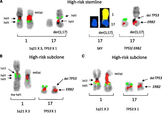 Figure 4. Partial karyotypes of patient 12 showing variable CNAs in different subclones for 1q21 in clones with deletion 17p. The direct loss of 17p occurred in the stemline by a whole-arm translocation of JT1q12. FISH probes on chromosome 1 are 1q12 (red) and 1q21 (green) and on chromosome 17 are TP53 (green) and ERB2 (red). SKY classified colors for 1q (yellow) and 17 (blue) are shown. (A) The stemline clone with chromosomes 1 (left) and 17 (right) showing JT1q12 replacing 17p (left bracket). This same pair of 17s was rehybridized 2 additional times with both SKY (middle dashed bracket) and FISH probes for TP53 and ERB2 (right dashed bracket). In this patient, 2 additional related subclones with variable CNAs for 1q21 were also identified. In both subclones, the JT1q12 on 17p has been lost (translocated off), leaving only the deleted 17p. In one subclone (panel B), the 1q21 CN remained at 3 due to the increase in CN of 1q21 in the normal chromosome 1, whereas in a second subclone (panel C), a CN of 2 was found for 1q21.