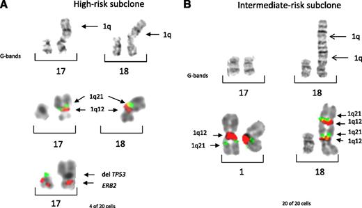 Figure 5. Partial karyotypes of patient 36 demonstrating similar but reconfigured CNs for 1q21 but a different CN for 17p in related clones. FISH probes 1q12 (red) and 1q21 (green), TP53 (green), and ERB2 (red) are shown. (A) In the first specimen, copies of JT1q12 were identified on both the 17p and 18p (top row, G-bands). FISH for 1q12 and 1q21 showed JT1q12 on both 17p and 18p with a 1q21 CN of 4 (middle row; normal chromosome 1 not shown). Probes for TP53 and ERB2 (bottom row) showed a CN of 1 for 17p. (B) In a second specimen analyzed 5 months later, normal chromosome 17 was identified by G-banding (top row), and a CN of 4 for 1q21 was found; however, both copies of JT1q12s were on the 18p (bottom row). This less-evolved clone indicates that the second copy of JT1q12 on the 18p in this clone is the JT1q12 that translocated to 17p, resulting in the deletion of TP53 in the previous specimen.