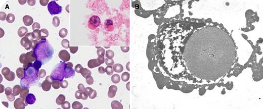 A 16-year-old girl presented with migratory bone pain. Her complete blood count revealed leukocytosis (24 190/μL) with circulating blasts. Bone marrow aspiration revealed 85% blasts, and immunophenotyping confirmed B-lymphoblastic leukemia (common acute lymphoblastic leukemia). Blast morphology was unusual, with a single large intracytoplasmic ground-glass inclusion displacing the nuclei (panel A). Immunohistochemical stains showed the inclusions were negative for IgM, κ, or λ light chains; serum immunoglobulins were normal. Cytogenetic analysis showed t(9;22)(q34;q11.2), and polymerase chain reaction testing confirmed the p190 BCR-ABL1 breakpoint. Electron microscopy showed nonspecific granular and somewhat fibrillar material in the inclusions, similar to Russell bodies (panel B). Despite the addition of dasatinib, her response to induction chemotherapy was poor, with 8% residual blasts. She did attain remission with subsequent chemotherapy plus a tyrosine kinase inhibitor, but had persistent minimal residual disease. She subsequently underwent allogeneic stem cell transplantation using 4/6 HLA-matched unrelated cord blood. She had multiple complications including severe graft-versus-host disease (GVHD) and ultimately died in remission 13 months after transplantation due to complications from chronic GVHD. / Russell bodies are well described in multiple myeloma and some lymphomas but rarely have been described in B-lymphoblastic leukemia. It is unclear whether this unusual blast morphology contributed to the patient's poor initial response and ultimate outcome.