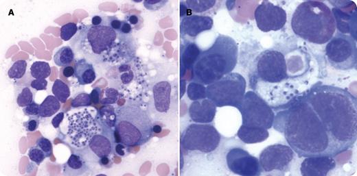 A 25-year-old Guatemalan man presented to the hospital with abdominal distension and fever. A computed tomography scan showed marked hepatosplenomegaly and bulky abdominal adenopathy. A complete blood count showed pancytopenia: white blood count, 7.7 × 109/L; hemoglobin, 7.0 g/dL; platelets, 48 × 109/L. White blood cell inclusions were present. Further work-up revealed AIDS with a CD4 count of 4 cells/μL. Evaluation of his anemia revealed a ferritin level of 85 000 ng/mL, which was a level that prompted consideration of hemophagocytic lymphohistiocytosis (HLH) as a unifying diagnosis. He fulfilled 5 of 8 diagnostic criteria: fever ≥38.5°C, splenomegaly, ≥2 cytopenias, ferritin level >500 ng/mL, and evidence of hemophagocytosis in the bone marrow. Prominent clusters of Histoplasma capsulatum were seen disseminated throughout the marrow aspirate (panel A). Serologic testing for Histoplasma antigen was positve. Hemophagocytosis was seen (panel B), in which a histiocyte is engulfing a red blood cell and several Histoplasma organisms. / HLH is a syndrome of pathologic immune activation characterized as primary or secondary in etiology. This patient had HLH secondary to disseminated histoplasmosis in the setting of severe immune deficiency. He received dexamethasone for treatment of HLH, as well as highly active antiretroviral therapy and antifungal treatment to treat the underlying infectious etiology. He recovered without incident and is doing well.