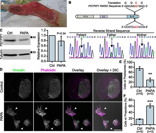 Figure 2. Macrophages from a PAPA syndrome patient have increased filopodia-like membrane projections. (A) Image of pyoderma gangrenosum on the PAPA patient’s right leg. (B) Reverse strand sequence traces from the PSTPIP1 genomic DNA sequencing of the patient, his mother, and his father. The diagram shows the location of the mutation at the DNA and protein level. (C) Western blots of lysate from control and PAPA macrophages was probed with mouse anti-PSTPIP1 and rabbit anti-β-tubulin (loading control) antibodies to determine relative PSTPIP1 expression. Arrowheads indicate location of molecular weight markers (kDa). PSTPIP1 expression in the PAPA patient macrophages was normalized to controls for quantification. (D) Representative images of podosomes and filopodia-like membrane projections in PAPA and control macrophages. Podosomes and filopodia-like structures were stained with anti-vinculin antibody (green) and rhodamine phalloidin (magenta). Arrowheads indicate filopodia-like projections in PAPA macrophages. (E-F) Quantification of the percentage of macrophages shown in (D) that form podosomes (E) and filopodia-like projections (F). Scale bar, 20 μm. All values are mean ± SEM from 3 (E,F) or 4 (C) independent experiments. **P < .01; ***P < .001 as determined by an unpaired Student t test (E,F) or paired Student t test (C).