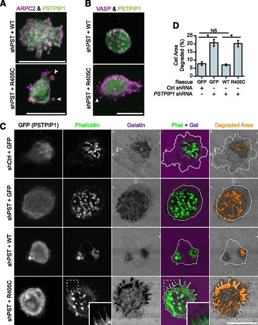 Figure 5. Filopodia associated with matrix degradation are induced by PSTPIP1 R405C. (A-B) Representative images of podosomes and filopodia formed in the THP-1 rescue cell lines. (A) The Arp2/3 complex was stained in podosomes and filopodia using anti-ARPC2 antibody (magenta) in THP-1 rescue cells expressing GFP-tagged PSTPIP1 constructs (green). (B) VASP was labeled in podosomes and filopodia with anti-VASP antibody (magenta) in THP-1 rescue cells expressing GFP-tagged PSTPIP1 constructs (green). (C) Representative images of gelatin degradation in the THP-1 rescue lines plated on Alexa Fluor 568–conjugated gelatin-coated coverslips (magenta). F-actin was stained with CruzFluor 405 phalloidin (green), and anti-GFP antibody (gray) was used to amplify the GFP signal. Orange pixels in the Degraded Area panel were those counted as degraded. (D) Quantification of the amount of gelatin degraded by the THP-1 rescue cells as a percentage of cell area. Scale bar, 20 μm. Values are mean ± SEM from 4 independent experiments. *P < .05, as determined by one-way ANOVA with Sidak’s multiple comparisons test. NS, nonsignificant.