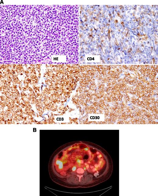 Figure 1. Representative pathology and PET images for our patient. (A) Dense CD30+ T-cell infiltrate in small bowel mass. (B) FDG-PET/CT fusion image showing multiple foci of lymphoma throughout the bowel.