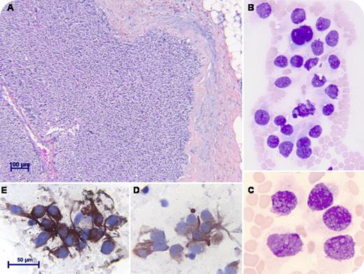A 48-year-old woman without a familial history of multiple endocrine neoplasia presented with cervical pain. A palpable thyroid nodule was found surrounded by enlarged lymph nodes. A high serum level of calcitonin (560 pg/mL, normal < 8) and low calcium evoked the idea of a medullary thyroid carcinoma (MTC). Serum carcinoembryonic antigen (CEA) was 7.5 ng/mL (normal < 4). Histopathological examination demonstrated sheets of polygonal cells with pseudoglandular arrangement and angioinvasion (hematoxylin-eosin; panel A). Despite extensive surgery, the disease progressed and metastasized to the liver. One year later, unexpected pancytopenia led to an investigation of the bone marrow. The infiltration was total, composed of clumps of round to spindle cells separated by amorpheous deposits (May-Grünwald-Giemsa; panels B-C). Immunohistochemistry showed positive tumor cells for calcitonin, chromogranin A (panel D), and synaptophysin (panel E), confirming the involvement of parafollicular calcitonin-producing C-cells. Calcitonin and CEA levels were increased to 316 pg/mL and 1723 ng/mL, respectively. The patient was treated by chemotherapy but soon died. / MTC represents <10% of all primary thyroid malignancies and may occur sporadically or in the context of type 2 multiple endocrine neoplasia. Tumor cells derive from C-cells. If local metastatic extension to the cervical nodes is frequent, distant metastasis to the lung, liver, and bone are rare, and the growth usually remains slow. Extensive surgery is the standard treatment of local forms, but targeted therapy is a promising alternative for widespread disease.