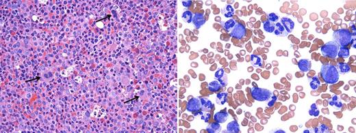 Figure 2. A case of aCML. (Left) BM biopsy (hematoxylin and eosin, ×500) reveals a hypercellularity (100%) with markedly increased myeloid:erythroid ratio (26:1). Dysplastic megakaryocytes are indicated by arrows; (right) PB smear (Wright Giemsa, ×1000) shows marked leukocytosis with many myeloid precursors (promyelocytes, myelocytes, and metamyelocytes, 23%). Neutrophils show peculiar abnormal nuclear segmentation. (Microscope: Olympus, Tokyo, Japan; camera and software: Q-Capture, Surrey, Canada.)