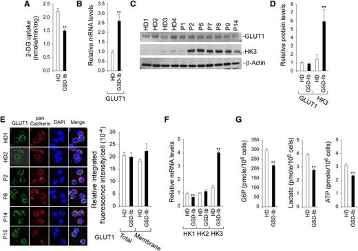 Figure 2. Analysis of 2-DG uptake, the expression of GLUT1 and HK, and levels of intracellular G6P, lactate, and ATP in G6PT-deficient neutrophils of GSD-Ib patients. Annexin V–depleted peripheral blood neutrophils isolated from HDs and GSD-Ib patients were used in the study. For quantitative RT-PCR, data represent the mean ± SEM for HDs (n = 10) and GSD-Ib patients (n = 12). (A) Uptake of 2-DG. Data represent the mean ± SEM for HDs (n = 3) and GSD-Ib patients (n = 3). (B) Quantification of mRNA of GLUT1 by real-time RT-PCR. (C) Western blot analysis of protein extracts using antibodies against GLUT1 and HK3. Each lane contains 50 μg of protein. (D) Quantification of GLUT1 and HK3 protein levels by densitometry. Data represent the mean ± SEM for HDs (n = 8) and GSD-Ib patients (n = 7). (E) Confocal analysis of GLUT1 (green fluorescence), pan Cadherin membrane staining (red fluorescence), and DAPI nuclei staining (blue fluorescence) at original magnification ×630. (F) Quantification of HK1, HK2, and HK3 mRNA by real-time RT-PCR. (G) Quantification of G6P, lactate, and ATP. Data represent the mean ± SEM for HDs (n = 13) and GSD-Ib patients (n = 12). **P < .005.