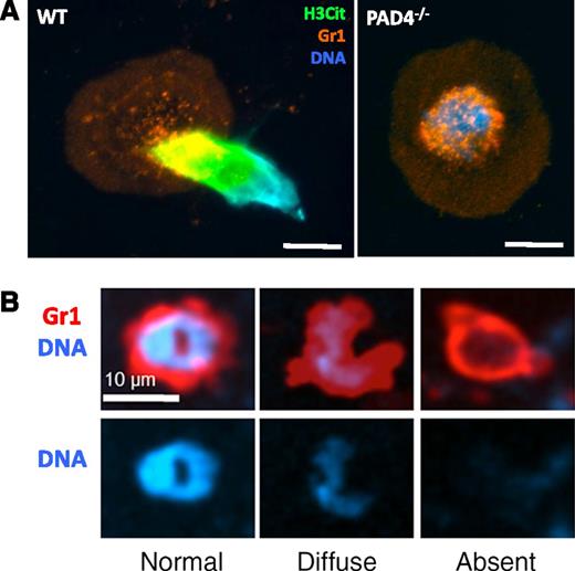 Figure 1. NETosis is a regulated process. (A) Representative image of a WT or PAD4−/− neutrophil stimulated with calcium ionophore. WT neutrophils undergo histone hypercitrullination (H3Cit, green) and throw NETs, whereas PAD4−/− neutrophils fail to citrullinate histones, decondense chromatin, or release NETs. Reproduced from Martinod et al.16 Scale bars, 10 μm. (B) In response to S aureus skin infection, neutrophils can secrete their nuclear contents (right) while retaining the ability to crawl and phagocytose, thus multitasking. Reproduced from Yipp et al with permission.19