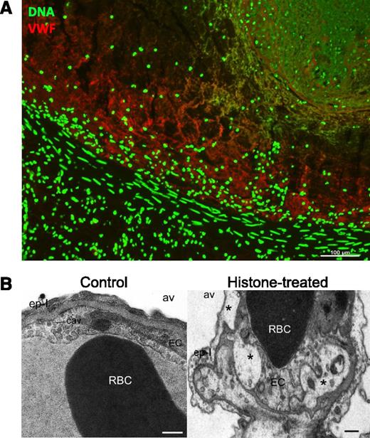 Figure 2. NETs are part of deep vein thrombi and histones produce toxicity in vivo. (A) A deep vein thrombus was formed in an otherwise healthy baboon by balloon catheterization. The thrombus was excised and analyzed for the presence of extracellular DNA (green) and von Willebrand factor (red), which were found to codistribute. Scale bar, 100 μm. Reproduced from Fuchs et al.31 (B) Intravenous histone infusion was detrimental to both endothelium and epithelium, as shown by vacuolization (stars) of these cells in and around the lung capillaries (right). Av, alveolae. Cav, caveolae. Ep-I, type I epithelial cell. EC, endothelial cell. Scale bars, 500 nm. Reproduced from Xu et al with permission.30