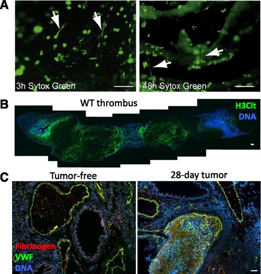 Figure 3. NETs form in mouse models of thrombosis and cancer. (A) Intravital microscopy of developing thrombi shows the release of NETs early (3 hours) and more prominently in occlusive thrombi (48 hours). Arrows indicate NETs. Sytox Green, DNA. Scale bars, 50 μm. Reproduced from von Bruhl et al.34 (B) Composite image of a thrombus formed in a WT mouse 48 hours after IVC stenosis. Mosaic generated using MosaicJ plug-in for ImageJ software.126 Citrullinated histone H3 (H3Cit) staining (green) shows evidence of a NET meshwork throughout the red portion of the thrombus. Scale bar, 100 μm. (C) Mice bearing a mammary carcinoma develop spontaneous thrombi in the lung (right) after 28 days, a time point when NETs are spontaneously generated in these mice. This does not occur in tumor-free mice (left). VWF, green. Fibrinogen, red. DNA, blue. Scale bar, 50 μm. Reproduced from Demers et al.71