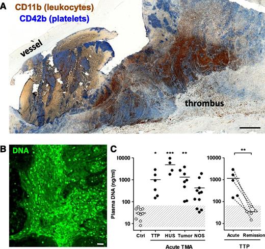 Figure 4. Evidence of NETs in human pathological thrombosis. (A) Composite image of a human pulmonary embolism specimen obtained surgically and stained by immunohistochemistry for platelets (blue) and leukocytes (brown) showing that areas of the thrombus are rich in both cell types. Scale bar, 100 μm. Mosaic generated using MosaicJ plug-in for ImageJ.126 Immunohistochemical analysis by Alexander Savchenko. (B) Representative image of diffuse extracellular DNA staining (green) present in a surgically harvested pulmonary embolism patient specimen. Green, DNA. Scale bar, 20 μm. Anonymous specimens in A and B kindly provided by Richard Mitchell. Most recently, specimens from 11 additional patients were evaluated and biomarkers of NETs were predominantly found in the organizing stage of human venous thromboembolism.127 (C) Cell-free DNA, a plasma biomarker of NETs, is elevated in patients with thrombotic microangiopathies (left): thrombotic thrombocytopenic purpura (TTP), hemolytic uremic syndrome (HUS), malignancies (tumor), and nonspecified cases (NOS). Patients suffering from acute TTP present significantly elevated plasma DNA compared with when in remission (right). This research was originally published in Blood. Fuchs TA et al. Circulating DNA and myeloperoxidase indicate disease activity in patients with thrombotic microangiopathies. Blood. 2012;120:1157-1164. © American Society of Hematology. Human thrombus samples were obtained by the Wagner Laboratory from Dr Richard N. Mitchell (Brigham and Women's Hospital, Boston, MA) as anonymous tissue specimens. Dr Mitchell's work was approved by Brigham and Women's Hospital Institutional Review Board 2013P000231.