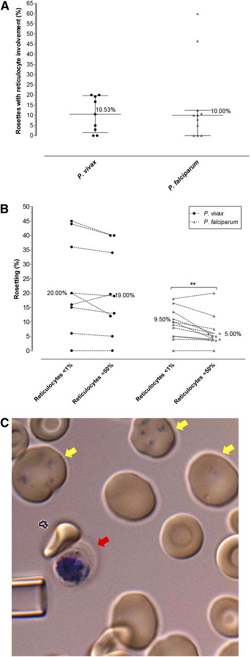 Figure 4. P vivax rosetting preference. (A) Percentage of rosettes associated with at least 1 reticulocyte in P vivax and P falciparum isolates in patient isolates already containing late-stage parasites (no ex vivo maturation). (B) Differences in rosetting rate of P vivax and P falciparum isolates in environment with <1% reticulocytes and approximately 50% reticulocytes (achieved by concentrating host reticulocytes on a 75% Percoll gradient). Lines connect paired observations. Altering the reticulocyte concentration had little effect on P vivax rosette formation; however, the number of normocytes attached to the P vivax IRBC was notably reduced in the treatment of enriched reticulocytes. Interestingly, an increase in the available reticulocytes reduced the ability of P falciparum to rosette (P < .01). (C) Reticulocytes were rarely associated with rosettes irrespective of the group or species observed. Here, a single normocyte is rosetting on a P vivax schizont (red arrow). The yellow arrows point to Heilmeyer stage IV reticulocytes subvitally stained with Giemsa. The tip of a glass micropipette with an internal diameter of 6 um is shown for scale.