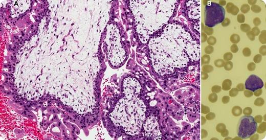Thirteen months after the successful treatment of a persistent complete hydatidiform mole (panel A: diffusely hydropic, grape-like chorionic villi surrounded by hyperplastic atypical trophoblast), a 27-year-old woman with no family history of cancer presented with fatigue, sore throat, and petechiae for a few weeks. Her prior treatment included a single cycle of single-agent methotrexate that was followed, because of a further increase in human chorionic gonadotropin, by 9 biweekly cycles of etoposide, methotrexate, dactinomycin, cyclophosphamide, and vincristine (EMA/CO regimen). Blood work at this time showed hemoglobin, 10.9 g/dL; white blood cells, 41.4 × 109/L; platelets, 15 × 109/L; and 60% blasts (panel B). The bone marrow was packed (95% cellularity) with immature myeloid cells that stained positively for CD13, CD33, CD34, and myeloperoxidase and negatively for CD3. Cytogenetic analysis revealed a core-binding factor β rearrangement at 16q22. A diagnosis of therapy-related acute myeloid leukemia (t-AML) was established. / Although t-AML after exposure to alkylating agents has a latency of 5 to 7 years, t-AML after exposure to topoisomerase II (TopoII) inhibitors has a shorter latency (1-3 years). Containing 2 TopoII inhibitors, 1 alkylating agent, 1 antitubilin agent, and 1 antimetabolite, EMA/CO carries a high risk of about 0.7% for future t-AML, and patients need close follow-up for several years after treatment.