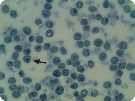 A 20-year-old splenectomized woman with hemolytic anemia, diagnosed at the age of 3 years with congenital dyserythropoietic anemia type I, was referred to our institution for re-examination of 2 unusual features: high red blood cell (RBC) pyruvate kinase (PK) activity and methemoglobinemia. On examination, she showed 3.5% methemoglobin and unusually high PK activity (45.0 U/gHb). Other RBC enzymes, notably hexokinase and glucose-6-phosphate dehydrogenase, also displayed high activities, suggestive of an RBC population of a very young age. Automated hematology analyzer measurements reported low reticulocyte numbers, but measurements were flagged as unreliable. We performed supravital staining with brilliant cresyl blue to determine reticulocyte numbers. Many cells displayed the blue-stained reticulum characteristic of reticulocytes. In addition, inclusion bodies reminiscent of Heinz bodies were noted (arrow). Together, this prompted us to re-evaluate the cause for hemolysis. Ultimately the patient was found to be heterozygous for a de novo p.Ala28Asp mutation in β-globin:Hb Volga. Substantial reticulocytosis, Heinz bodies, and methemoglobinemia are prominent features of this unstable hemoglobin variant. / Supravital staining is very rarely used in current hematological laboratory practice. In this case, it enabled us to reliably estimate reticulocyte numbers and provided a clue toward revision of the diagnosis in this patient.
