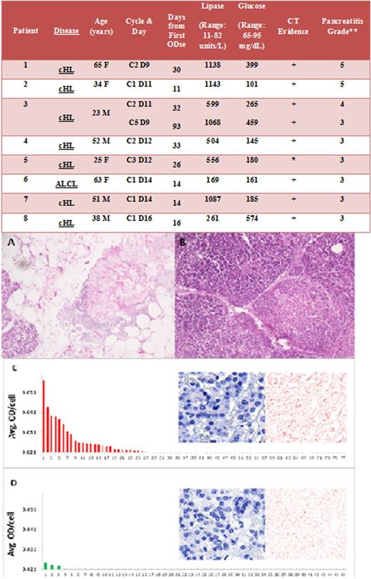 Figure 1. Clinical characteristics of patients with pancreatitis after treatment with BV, and autopsy specimen histology and quantitative immunohistochemistry with multispectral imaging (patient 1). (A) Autopsy specimen demonstrating fat necrosis of pancreas. (B) Autopsy specimen demonstrating coagulation necrosis of pancreas. (C) CD30 immunohistochemistry slide. Histogram: CD30 positivity in 27 (35%) of the 77 analyzed cells, with background optical density (OD) subtracted from all values. The bars signify specific CD30 staining. Insert: Standard light microscopic images of CD30 immunohistochemistry slide (left) and corresponding computer-generated image of pure 3,3′-diaminobenzidine signal (right), signifying CD30 expression in this biopsy. (D) Mouse immunoglobulin control slide. Histogram: The average OD values per cell are depicted. Here, a small subset of cells show OD values that exceed the range of 2 standard deviations from mean, an expected finding assuming a normal distribution of OD values. Insert: Standard light microscopic image of mouse immunoglobulin slide (left) and the corresponding computer-generated image of pure 3,3′-diaminobenzidine signal (right), showing nonspecific staining. Note: Data are expressed as average OD per cell. CD30 positivity is defined as any average OD per cell greater than nonspecific background OD (in this case, 0.021 plus 2 standard deviations from the mean, a value determined by measuring OD values in the mouse immunoglobulin control slide). cHL, classical Hodgkin Lymphoma; ALCL, anaplastic large cell lymphoma; CT, computed tomography. *Ultrasound showed only biliary sludge; **CTCAE 4.03 (evs.nci.nih.gov).