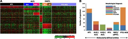 Figure 1. Molecular diagnostic signatures of PTCL subgroups. (A) Unique gene expression signatures were identified for major PTCL entities using compound covariate prediction model (see Materials and methods for details), and the predictor score from top ranking genes for each subtype was used to classify a PTCL patient. ALCL and ENKTL groups are further differentiated into ALK(+)ALCL and ALK(–)ALCL, and NK and γδ T-cell subgroups, respectively. Each column represents a PTCL patient and each row represents a unique gene of the classifier. The relative gene expression scale is indicated below. (B) Pathological vs molecular diagnosis comparison. Substantial number of cases from PTCL-NOS were molecularly classified into WHO recognized PTCL subgroups: (i) AITL (n = 21, 14%); (ii) ALK(–)ALCL (n = 17, 11%); (iii) ATLL (n = 4, 3%); (iv) γδ-PTCL (n = 13, 9%). However, 26 AITL cases (22%) were not molecularly classifiable and changed to PTCL-NOS.