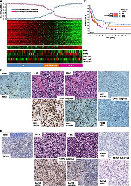 Figure 3. Two major molecular subgroups within PTCL-NOS with biological and overall survival differences. (A) Bayesian predictor for the GATA3 and TBX21 subgroups was derived using cases from hierarchical cluster 1 and cluster 2. LOOCV was used for classification precision. (B) Overall survival (OS) analysis of molecularly-defined GATA3 and TBX21 subgroups showed significant difference in clinical outcome (P = .01). A subset of cases mentioned in the text lacked clinical outcome data and are not included in OS analysis. (C) Representative cases in the TBX21 subgroup (H&E) with TBX21 immunostain showed positivity ranging from 40% to 80% of cells, whereas positivity in the GATA3 subgroup was <10%. (D) Representative cases in GATA3 subgroup immunostained with GATA3 showing positivity ranging from 50% to 80% of cells, and were negative for TBX21.