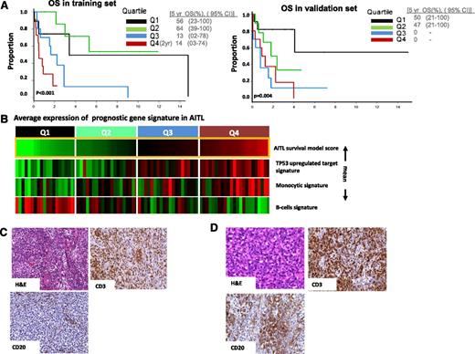 Figure 4. Survival prediction in AITL. (A) Prognostic model in a training set and validated on an independent validation set. The optimal model represents that cases with high B-cell signature and low monocytic signature show favorable outcome compared with other cases (P = .004). (B) AITL cases are arranged according to model score, which represents differences between averages expression of B-cell signature and monocytic/P53 signature (mean). (C) Representative case from the upper (4th) quartile of the model score showing fewer CD20+ cells, whereas in (D) cases in lower(2nd) quartile showed a higher number of CD20+ B cells.
