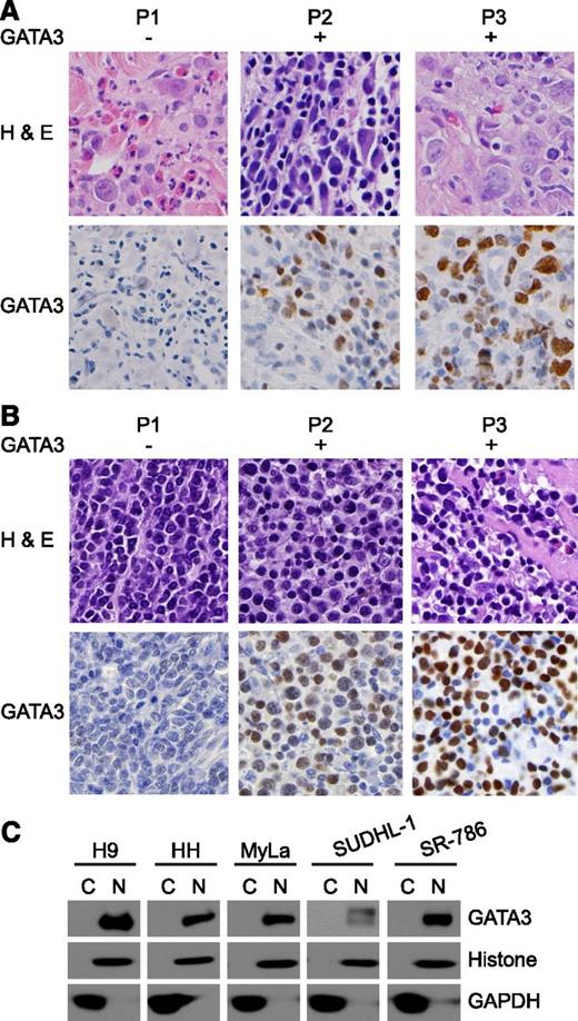 Figure 3. GATA-3 expression in T-cell lymphoproliferative disorders. GATA-3 expression was determined by immunohistochemistry in (A) CTCL and (B) PTCL, NOS clinical specimens. Three representative cases (P1-P3) are shown. (C) Cytoplasmic (C) and nuclear (N) fractions were obtained from the patient-derived TCL lines shown, and GATA-3 expression was determined by western blot.