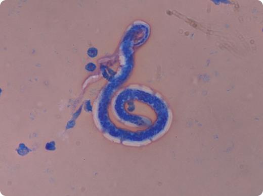 A 25-year-old Indian man from Mumbai presented 5 months after arrival in Singapore in 2013 with fever and myalgia for 5 days. Physical examination was unremarkable. Laboratory investigation showed total white cell count 5.21 × 109/L (3.4-9.6 × 109/L), hemoglobin 13.9 g/dL (12.9-17.0 g/dL), platelets 24 × 109/L (132-372 × 109/L), neutrophils 88.9%, lymphocytes 6.3%, and eosinophils 0%. The renal and liver function tests were normal. Malaria microscopy revealed trophozoites of Plasmodium vivax (parasite load of 0.40%). He was treated with chloroquine and 14 days of primaquine for eradication of hypnozoites. A repeat peripheral blood smear after treatment revealed eradication of malaria parasites but the presence of another parasite measuring 250 µm in length as shown in the figure. / He was diagnosed with microfilaremia (Wuchereria bancrofti). He was treated with 1 dose of ivermectin (12 mg) and doxycycline (100 mg) twice a day for 6 weeks. He returned to India and was lost to follow-up.