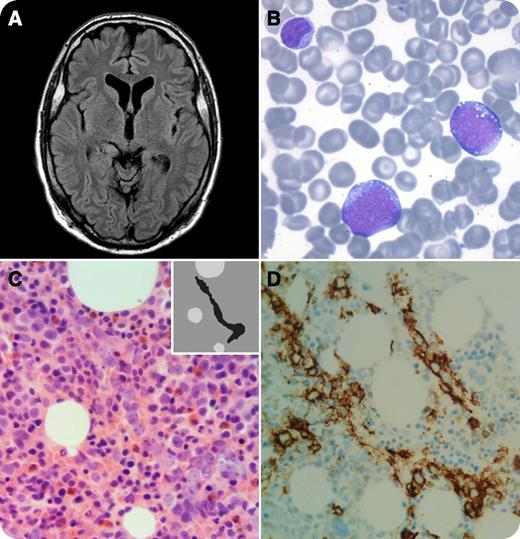 A 50-year-old man with a negative medical history presented with aphasia and influenza-like symptoms over the course of 2 days. He was transferred to our university hospital because of unexplained encephalopathy with mutism and apraxia. Laboratory analysis revealed an elevated lactate dehydrogenase level of 1282 U/L (reference range, <250 U/L) and a normal leukocyte count with normal differentiation. Cerebrospinal fluid examination was negative for an infection, and only a few normal T cells were present. Surprisingly, magnetic resonance imaging of the brain (panel A) did not show any abnormalities, and computed tomography also failed to show lymphadenopathy. Unfortunately, the patient developed respiratory insufficiency after a seizure and was then intubated. A bone marrow smear showed large blast-like cells with prominent nucleoli (panel B), and immunophenotyping showed a small CD45 weak population (2%) positive for CD19, CD20, and HLA-DR and negative for CD34, CD10, T markers, and myeloid markers. / Treatment with rituximab–cyclophosphamide-doxorubicin-vincristin-prednisone was directly initiated, and in less than a day, the patient was detubated. A few days later, the bone marrow biopsy demonstrated intravascular cells positive for CD20 (panels C and D) and negative for a c-myc translocation, with a high Ki-67 proliferative index (>90%). This confirmed the diagnosis of intravascular lymphoma. The patient was discharged within a week after extubation.
