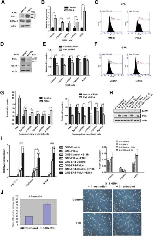 Figure 1. PML4 promotes terminal erythroid differentiation through GATA-1. (A-C) Forced expression of PML4 promotes K562 erythroid differentiation. K562 cells were infected with a retrovirus that expressed PML4 cDNA. (A) Western blot was performed to detect overexpression of PML. (B) Real-time RT-PCR was performed for AHSP and globin gene expression. (C) Flow cytometry was used to detect expression of GPA. (D-F) PML knockdown in K562 cells leads to reduced expression of erythroid genes. K562 cells were infected with a retrovirus harboring an shRNA to knock down PML (or GFP as a control). (D) Western blot assay, (E) real-time RT-PCR, and (F) flow cytometry were performed as in A-C. (G) Human primary erythroid progenitors were expanded and induced to erythroid differentiation by EPO. At day 1 of differentiation, retroviral vectors for PML4 overexpression or PML knockdown were transfected. PML and β-like globin genes expression were determined on day 4 of differentiation. (H-J) PML4 promoted erythroid maturation of G1E-ER4 but not G1E. PML4 and control plasmids were stably overexpressed in G1E and G1E-ER4 cells by retrovirus infection and induced to erythroid differentiation by adding β-estradiol for 18 hours of treatment. (H) Western blotting analysis of GATA-1 and PML4 expression in PML4 overexpressing and control G1E, G1E-ER4 cells before and after β-estradiol induction. (I) Real-time RT-PCR analysis of AHSP and α- and β-globin genes expression in PML4 overexpressing and control G1E and G1E-ER4 cells before and after β-estradiol induction. Right panel shows the enlarged bars from G1E cells. (J) Benzidine staining of PML4 overexpressing and control G1E-ER4 cells before and after 18 hours of β-estradiol induction for GATA-1 recovery. PML4 promotes hemoglobin production, especially in β-estradiol–induced G1E-ER4 cells.
