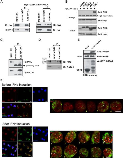 Figure 2. PML4 directly interacts with GATA-1. (A) Reciprocal Co-IP of exogenous HA-PML4 and myc-GATA-1 in 293T. (B) Interaction of GATA-1 and PML isoforms in IP assays. GATA-1 interacts with PML4 specifically. (C) Interaction of PML4 and endogenous GATA-1 in β-estradiol–induced G1E-ER4 cells. IP was performed with rat anti–GATA-1(N6), followed by immunoblotting with anti-PML (PG-M3). (D) Interaction of endogenous PML and GATA-1 in erythroid-differentiated human umbilical CD34+ cells. (E) GST-pulldown assay with in vitro expressed GATA-1 (fused to GST) and PML4 (fused to MBP) shows direct interaction between PML4 and GATA-1. CBB staining, Coomassie brilliant blue staining. (F) Colocalization of endogenous PML and GATA-1 in erythroid-differentiated human umbilical cord CD34+ cells. Immunofluorescence analyses of endogenous PML (red) and GATA-1 (green) were carried out in the primary erythroid cells at day 6 of EPO induction without (upper) or with (lower) IFNα induction (1000 U/mL, 24 hours) of PML expression. The white arrows in the enlarged panels indicate sites of colocalization. All images were acquired on an Olympus FV1000 Confocal microscope using the Olympus FV1000 Viewer software, version 3.0a; scale bars, 5 μm.