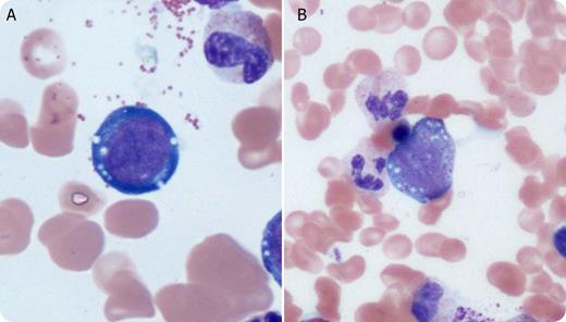 A 56-year-old woman with a complicated medical history presented with nausea, vomiting, neuropathy, and chronic weakness. Complete blood count (Hb 54 g/L, MCV 99 fL, white blood cell count 5.0 × 109/L, neutrophil count 3.5 × 109/L, platelets 374 × 109/L, reticulocyte count 46 × 109/L) showed she was markedly anemic with a normal reticulocyte count. The etiology of the anemia was not evident from a review of the blood smear. A bone marrow examination showed prominent vacuolated erythroblasts (panel A) and vacuolated myeloid precursors (panel B). Ring sideroblasts were also present. Cytogenetics showed a normal karyotype (46, XX). Additional laboratory investigations showed markedly decreased copper 0.6 (11.3-25.2 μmol/L), decreased ceruloplasmin 29 (220-495 mg/L), and elevated zinc 18.7 (9.2-18.5 μmol/L). Review of her medications showed long-term oral zinc gluconate therapy. Longer-term follow-up showed normalization of anemia with oral copper supplementation, but the neurologic defects persisted. / Acquired sideroblastic anemia secondary to zinc excess causing copper deficiency is rare; however, it is important to diagnose this benign condition early, as the neurologic symptoms may become irreversible. Patients may present with nonspecific clinical symptoms and laboratory findings, resulting in a delay in diagnosis or a misdiagnosis as a myelodysplastic syndrome.