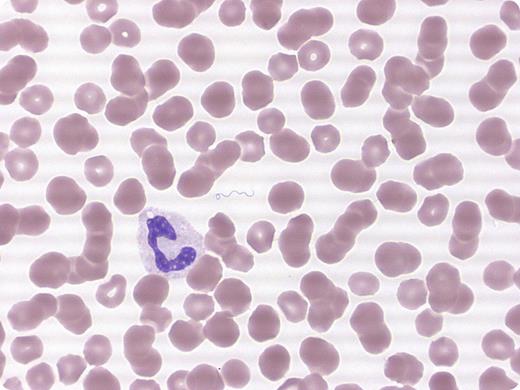 A 49-year-old healthy female presented to the emergency department with a headache, fever to 103°F, mild myalgia, heart rate of 119 bpm, and blood pressure of 80/40 mm Hg. Past medical history was unremarkable, no drug allergies or current medications, except for a recent vacation in eastern Washington state. The complete blood count showed a white blood cell count of 12.5 × 10E9/L (mild leukocytosis with left shift), thrombocytopenia (32 000/µL), normal electrolytes, and an elevated C-reactive protein (19.8 mg/dL). Blood cultures were sterile. The peripheral blood smear revealed spirochetes morphologically resembling Borrelia species (Borrelia sp) and were considered confirmatory for relapsing fever (RF). Serological testing for Borrelia sp on acute and convalescent specimens exhibited negative and positive immunoglobulin G antibodies to B hermsii, respectively. She was treated with ciprofloxacin and made a full recovery. / Although the therapy for tick- or louse-borne borreliosis is well established and the response to antibiotics is predictably good, RF is a communicable disease and must be reported by laboratories to the local health department.