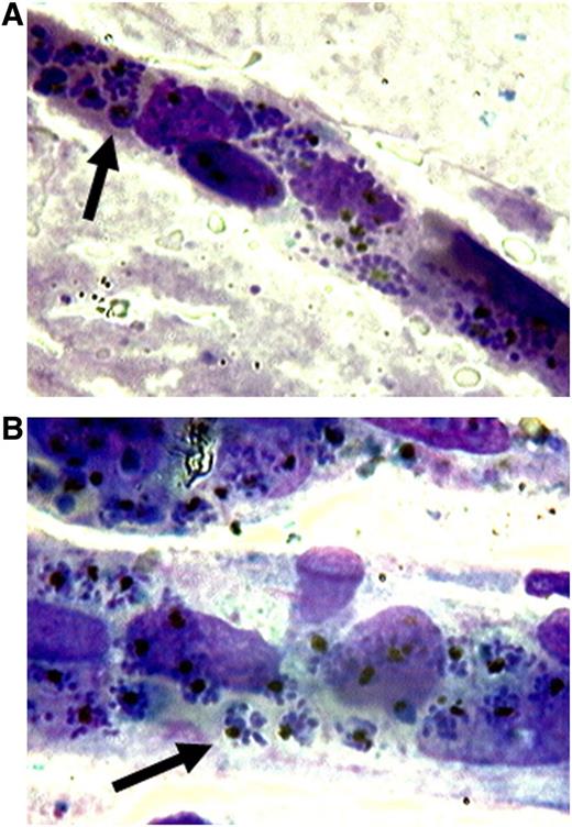 P falciparum sequestration in the microcirculation. Postmortem brain smears (magnification ×1000) taken from an adult Vietnamese patient who died of cerebral malaria showing intense packing of IRBCs in the microvasculature. The arrow in panel A indicates an IRBC with a mature trophozoite. The small round bodies to the right are free merozoites and/or malaria pigment after IRBC rupture. The arrow in panel B indicates an intact schizont with a cluster of merozoites within an IRBC. Note the absence of any inflammatory infiltrate. (Courtesy of Dr K. Silamut, Mahidol Oxford Research Unit, Bangkok, Thailand.)