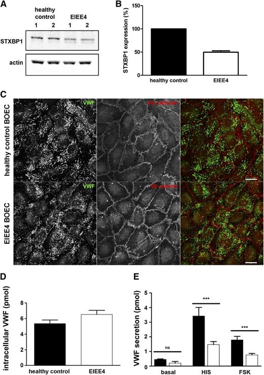 Figure 6. Impaired Ca2+- and cAMP-mediated VWF secretion in EIEE4 BOECs. (A) Healthy control donor and EIEE4 BOEC lysates were separated by SDS-PAGE and were probed with rabbit anti-STXBP1 or mouse anti-actin antibodies followed by incubation with IR dye–labeled donkey anti-rabbit or anti-mouse IgG. (B) Quantification of STXBP1 expression in healthy control donor (black) or EIEE4 BOECs (white) (n = 3). (C) EIEE4 and control donor BOECs were fixed with paraformaldehyde and immunostained for VWF (green) and VE-cadherin (red). Bar represents 10 μm. (D) Endothelial cells were lysed in SF medium containing 1% Triton X-100 and lysates of healthy control donor (black) or EIEE4 BOECs (white) were assayed for VWF content by ELISA. (E) BOECs were incubated for 30 minutes with SF medium (basal), SF medium supplemented with 10 μM forskolin and 100 μM IBMX (FSK), or with 100 μM histamine (HIS). Supernatants were assayed for secreted VWF by ELISA. ***P < .005; n = 3.