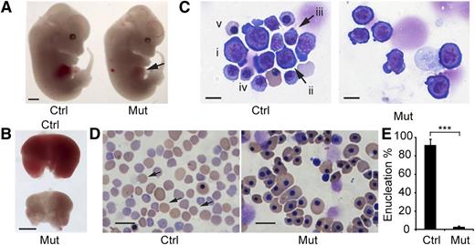Figure 2. Rcor1 null embryos exhibit defective embryonic erythropoiesis. (A) E13.5 control (Ctrl) and mutant (Mut) littermates. Note pale liver in mutant (arrow). Scale bar: 1 mm. (B) Comparison of E13.5 control and mutant fetal livers. The mutant fetal liver is smaller and paler than the control fetal liver. Scale bar: 1 mm. (C) May-Grunwald Giemsa staining of E13.5 fetal liver cytospin preparations. The control liver contains early erythroid progenitors (i: BFU-E or CFU-E like cells; ii: proerythroblast) and late erythroid precursors (iii: early basophilic erythroblast; iv: late basophilic erythroblast; v: orthochromatophilic erythroblast). The mutant fetal liver contains primarily early-stage erythroid progenitors. Scale bar: 10 μm. (D) May-Grunwald Giemsa staining of E15.5 peripheral blood smears showing enucleated definitive erythrocytes (arrow) in the control that are lacking in the mutant. In the mutant, nearly all the circulating blood cells are primitive wave erythroid cells of normal appearance. Scale bar: 20 μm. (E) Mean of enucleated RBC frequency in control (n = 5) and mutant (n = 3) E15.5 peripheral blood. Error bars show standard deviation (SD). ***P < .001. Images for (A-B) were taken with a Zeiss SteREO Lumar.V12 microscope, a Neo-Lumar S ×0.8 FWD 80-mm objective and an AxioCam HRc camera. Images for (C-D) were acquired with a Zeiss Axiovert S-100 (Carl Zeiss), an AxioCam HRc camera, and either (C) a Zeiss plan-neofluar ×100/1.30 oil lens or (D) a Zeiss plan-neofluar ×40/1.30 oil lens.