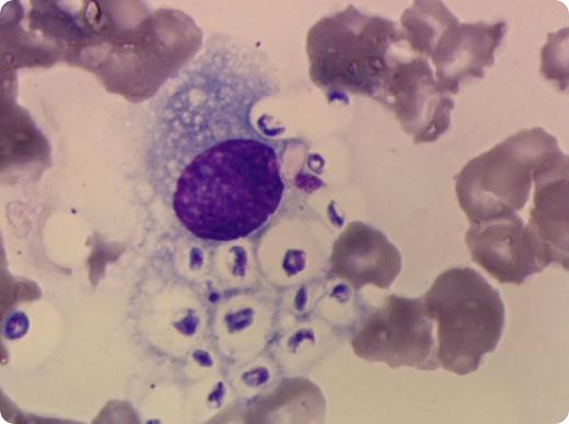 A 77-year-old white woman who was followed for an IgA-λ multiple myeloma (MM) was admitted for the development of neurological symptoms. Her International Staging System stage III MM had been diagnosed incidentally 8 years prior. After 3 relapses, she was treated with a combination of corticosteroids, cyclophosphamide, and pomalidomide and was believed to be in complete remission. Complete blood count readings showed mild anemia (hemoglobin 105 g/L), normal white blood cell count (7.8 × 109/L) with severe lymphopenia (0.15 × 109/L), and severe thrombocytopenia (41 × 109/L), which prompted a bone marrow (BM) aspiration. BM examination revealed no signs of dysmegakaryopoiesis or plasma cell invasion, but there were several histiocytes with intracellular encapsulated bodies identified as fungal cells. Disseminated cryptococcosis caused by Cryptococcus neoformans was confirmed by India ink stain and a cryptococcal antigenemia test was run on the cerebrospinal fluid. BM examination suggested the diagnosis that was confirmed by additional tests. Treatment with associating high doses of amphotericin B and flucytosine was quickly started, but the patient died 10 days later. / Cryptococcus neoformans infection is rare among immunocompetent patients. Although the patient was given polyvalent human immunoglobulins (IgG, IgA, and IgM levels were normal: 7.3 g/L, 2.34 g/L, and 0.17 g/L, respectively), the long-term immunosuppressive therapy caused severe TCD4+ lymphopenia (0.064 × 109/L) and was instrumental in allowing the infection and dissemination of the yeast.