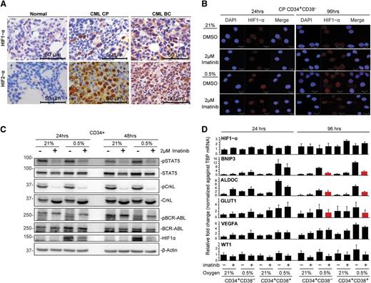 Figure 4. Hypoxia induces HIF1-α expression in CML progenitors that can be partially attenuated by imatinib. (A) Representative immunohistochemical staining for HIF1-α and HIF2-α proteins in normal, CP, and BC CML BM specimens. (B) Immunofluorescence detection of HIF1-α protein expression in CD34+CD38− and CD34+CD38+ populations. Results show representative images of 4 independent experiments. Scale bars represent 10 µm. (C) The levels of HIF1-α, pBCR-ABL1, pSTAT5, and pCrkL in CD34+ CML samples were detected by western blotting. Representative images of 2 independent experiments are shown. (D) The expression of HIF1-α, hypoxia-regulated genes (BNIP3, VEGFA, ALDOC, and GLUT1), and the BCR-ABL1-regulated gene WT1 in CD34+CD38− and CD34+CD38− subpopulations is shown. Expression was quantified by real-time quantitative polymerase chain reaction after normalization against the housekeeping gene, TBP (n = 3). Red bars highlight genes induced by hypoxia and downregulated by concurrent imatinib treatment.