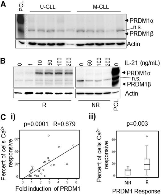 Figure 1. Induction of PRDM1 following treatment with IL-21 in CLL cells correlates with anergy. (A) Basal (ie, unstimulated) levels of PRDM1 protein in M-CLL and U-CLL samples (n = 5 each). A PCL sample was used as a positive control. n.s.: nonspecific band detected by the PRDM1 antibody. β-actin was analyzed as a loading control. (B) PRDM1 induction in representative “responsive” (R) and “non-responsive” (NR) CLL samples after 2 days in culture with the indicated concentrations of IL-21 (n = 3). (C) Correlation of PRDM1α protein induction in cells treated with 50 ng/mL IL-21 for 16 hours. The maximum percentage of cells that showed increased iCa2+ following anti-IgM stimulation: (i) shows linear correlation between these variables, and (ii) shows significant statistical difference in iCa2+ responsiveness between PRDM1 NR (≤twofold induction) and R (>twofold induction) CLL samples (n = 26). Fold induction of PRDM1α was calculated as a ratio by western blot densitometry between the IL-21–treated and untreated samples. The results of statistical evaluation are shown, (i) Pearson’s coefficient, and (ii) Mann-Whitney U test.
