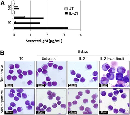 Figure 4. Induction of PRDM1 in responsive CLL samples correlates with increased differentiation. (A) Secreted IgM levels after 5 days of treatment of responsive (R) and nonresponsive (NR) CLL samples with IL-21. (B) Morphology of representative responsive and nonresponsive CLL samples (n = 3 each) examined directly ex vivo (T0), after 5 days in culture medium alone (untreated), or after 5 days of stimulation by IL-21 with and without co-stimuli (anti-IgM, CD40L, and IL-2) (×100 magnification; Nikon ACT-1 v2.63 microscope software Giemsa staining).