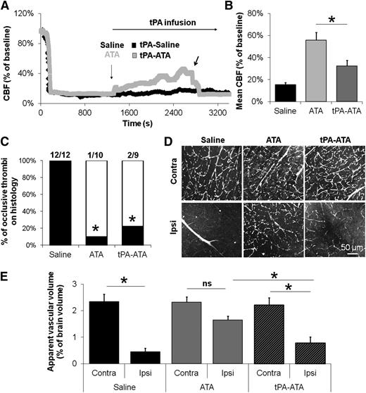 Figure 6. Fibrinolysis during GpIbα-VWF interaction blockade promotes embolization of large platelet aggregates from the thrombus and impairs distal microcirculation. (A) Representative laser Doppler profiles of mice treated with saline or ATA followed by continuous infusion of tPA. The black arrow indicates a sudden drop in CBF during tPA infusion, probably due to embolism. (B) Mean CBF at the end of the monitoring period (40 minutes posttreatment, n = 10-11). (C) Proportion of animals with occlusive thrombi on histology 1 hour after treatment injection (n = 9-12). (D) Representative multiphoton images of Evan’s blue-injected mice 1 hour after saline, ATA, or tPA-ATA treatment. Both ipsilateral and contralateral sides are represented. (E) Mean apparent vascular volume in saline-, ATA-, and tPA-ATA–treated mice 1 hour after administration (n = 4/group). ns, not significant.