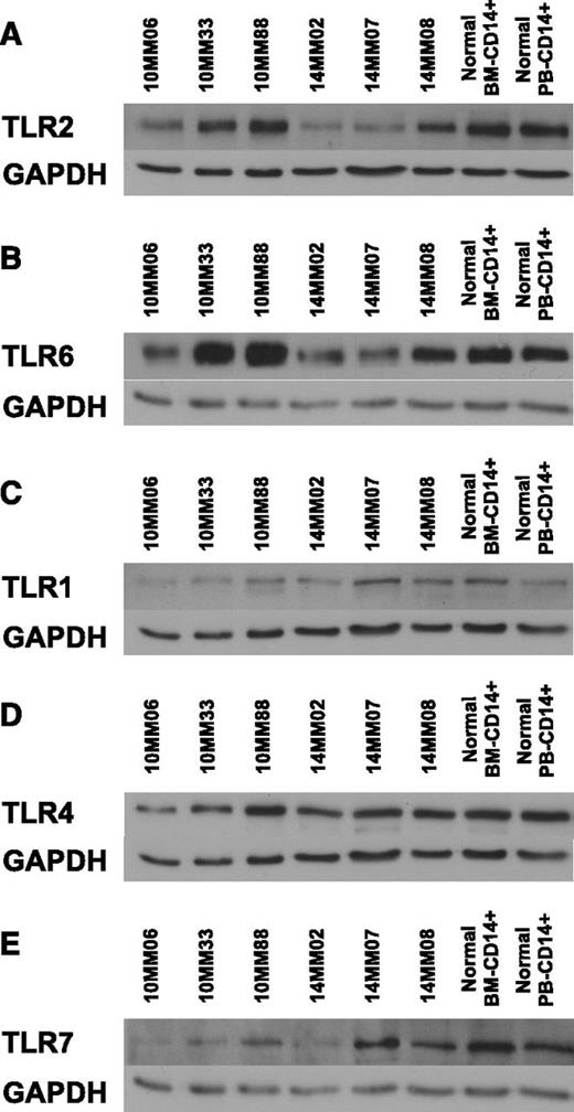 Figure 2. Coregulation of TLR2 and TLR6 expression in MAMs. Lysates from CD14+ MAM obtained from BM aspirates at diagnosis were immunoblotted using a panel of antibodies against TLRs. Human primary BM-derived CD14+ cells and human primary peripheral blood (PB)-derived CD14+ cells served as controls. GAPDH provided a loading control. (A) TLR2/GAPDH. (B) TLR6/GAPDH. (C) TLR1/GAPDH. (D) TLR4/GAPDH. (E) TLR7/GAPDH. GAPDH, glyceraldehyde-3-phosphate dehydrogenase.