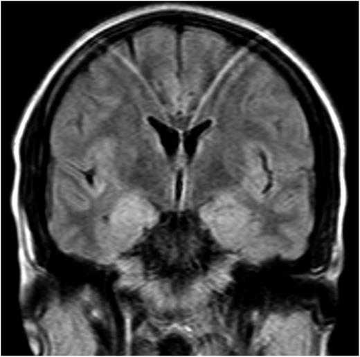 Figure 2. Coronal T2-weighted MRI scan of a patient with LE, mGluR5 antibodies, and HL. There is increased T2 signal of the head of both hippocampi. Study is slightly affected by motion artifact.