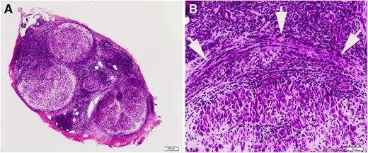 Figure 5. Sural nerve biopsy of a patient with a final diagnosis of neurolymphomatosis. (A) Low power figure of the sural nerve biopsy showing infiltration by lymphomatous cells. (B) The infiltrate involves all layers of the nerve. Arrowheads indicate the perineurium.