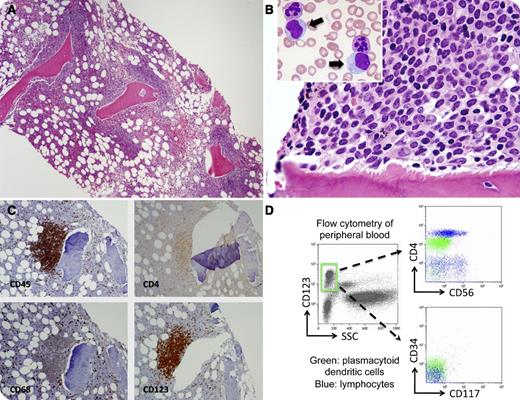 A 63-year-old man with a history of end-stage renal disease and hypertension underwent a bone marrow biopsy for leukocytosis (white blood cells 19.5 × 109/L, monocytes 2.9 × 109/L) and anemia (hemoglobin 96 g/L). The bone marrow was hypercellular with features of a myelodysplastic/myeloproliferative neoplasm consistent with chronic myelomonocytic leukemia (CMML). In addition, there were several focal paratrabecular infiltrates of mononuclear cells (panel A) that were small to medium-sized with round-to-oval nuclei and delicate chromatin patterns (panel B). The peripheral blood (panel B, inset arrows) and bone marrow aspirate contained a small percentage of similar cells with lightly basophilic cytoplasm, delicate chromatin, and occasional indistinct nucleoli. Immunohistochemistry showed that the paratrabecular infiltrates were positive for CD45, CD4 (dim), CD68, and CD123 (panel C), and were negative for CD34, CD117, myeloperoxidase, tryptase, CD3, CD5, CD7, CD20, PAX5, CD56, and CD79a. In addition, flow cytometric studies of the peripheral blood and bone marrow aspirate identified a small population of plasmacytoid dendritic cells that were positive for CD123 (panel D, gated), CD45 (dim), CD33, and CD4, and were negative for CD34, CD117, TdT, CD56, CD13, and CD11c. / Although plasmacytoid dendritic cell infiltrates in myeloid neoplasms, especially CMML, are well known, the bone marrow paratrabecular infiltration pattern similar to lymphoma and the documented peripheral blood involvement in this case are unusual.