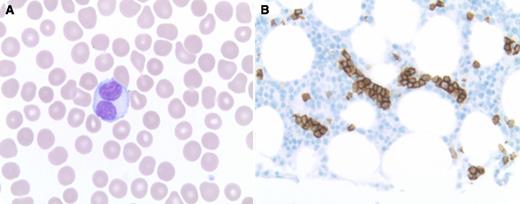 An asymptomatic 49-year-old female presented with lymphocytosis (11.1 × 109/L lymphocytes) and thrombocytopenia (128 × 109/L platelets), with no additional cytopenias or physical findings. The blood film revealed lymphocytes of varying morphology, including unusual cells displaying bilobed nuclei (panel A). Bone marrow biopsy revealed mild interstitial B-cell lymphocytosis that included foci of intrasinusoidal localization highlighted by CD20 (panel B). Flow cytometry revealed a predominance of polyclonal B cells lacking additional antigenic aberrancies (peripheral blood and bone marrow). / A diagnosis was made of persistent polyclonal B-cell lymphocytosis (PPBL), a rare type of lymphocytosis. Associations include female gender, cigarette smoking, and polyclonal increase in immunoglobulin M (IgM) (both found in this case), as well as an HLA DRB1*07 haplotype (not assessed). There is potential for confusion with lymphoid neoplasia, given the presence of lymphocytosis, unusual lymphocyte morphology (bilobed lymphocytes characteristic), and splenomegaly (may be progressive). Bone marrow findings may also be misleading if they show an intrasinusoidal pattern of B-cell localization more commonly seen with a lymphoma such as splenic marginal zone lymphoma. Chromosomal abnormalities may be seen, including IgH-BCL2 rearrangement (not found in this case). However, B cells are polyclonal by flow cytometry, and clonal Ig gene rearrangements are not found in B cells. Growing experience with PPBL has not suggested an increased risk of evolution to lymphoma.