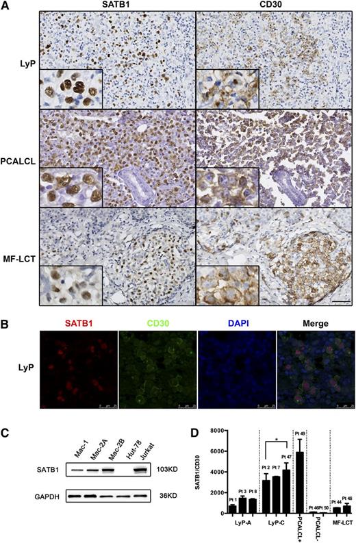 Figure 1. SATB1 and CD30 expression in cutaneous CD30+LPDs. (A) Paraffin-embedded tissues from LyP, PCALCL, and MF-LCT patients were analyzed with immunohistochemistry. The large, atypical tumor cells showed bright diffuse nuclear staining of SATB1, and they coincided with CD30 staining (original magnification ×400, scale bar = 20 µm). (B) Immunofluoresence with double staining demonstrated specific SATB1 expression (red) in CD30+ cells (green) in LyP, whereas the surrounding reactive small T cells were negative for SATB1 or CD30. DAPI (blue) was used for visualize cell nuclei (scale bar = 25 µm). (C) SATB1 protein expression was detected in all 3 PCALCL cell lines with Western blot. Jurkat and Hut78 cell lines, derived from T lymphoblasts and Sézary cells, respectively, served as controls for high and low SATB1 expression in CD30+ T cells. (D) SATB1 expression levels relative to CD30 in CD30+LPD clinical samples. PCALCL+, PCALCLs positive for SATB1; PCALCL–, PCALCLs negative for SATB1; Pt, Patient no. *P < .05. Biological replicates for each cell were repeated 3 times.