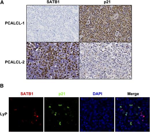 Figure 5. SATB1 and p21 expression in CD30+LPD clinical samples. (A) Immunohistochemistry shows diffuse p21 expression in SATB1– PCALCLs (PCALCL-1), whereas in SATB1+ PCALCLs (PCALCL-2), p21+ cells were <20%. (B) Double staining on LyP samples shows that, among large atypical lymphocytes, SATB1 (red) and p21 (green) detect distinct populations of atypical cells. Only a small portion of SATB1– reactive lymphocytes was positive for p21 staining. DAPI (blue) was used to visualize cell nuclei.