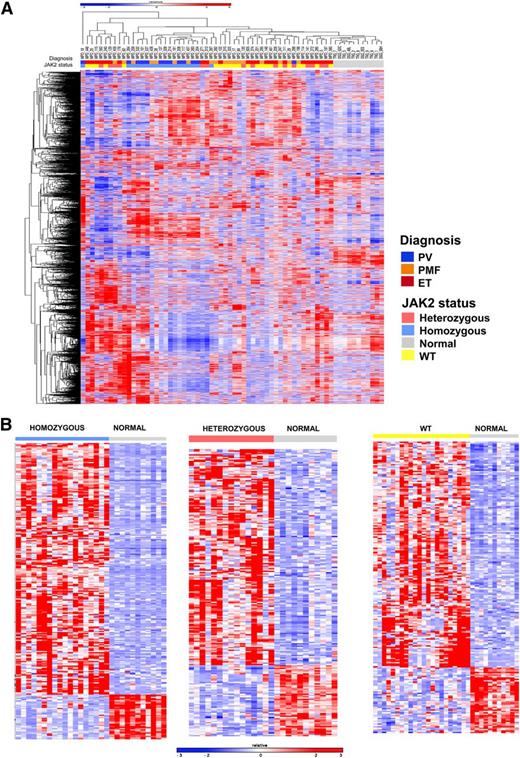 Figure 1. Gene expression profiling distinguishes patients with MPN from normal controls and homozygous JAK2V617F-mutant MPN patients from others. (A) Hierarchical clustering was performed on gene expression microarray data from the granulocytes of 55 MPN patients and 11 normal subjects. MPN patients were characterized by a distinct gene expression profile compared with normal subjects. Correlation of patient samples with clinical MPN subtype and JAK2 genotype showed that MPN patients with homozygous JAK2V617F mutations were characterized by a unique cluster of differentially expressed genes among MPN patients. (B) Heatmap representation of significant differentially expressed genes between normal subjects and MPN patients with homozygous JAK2V617F (265 genes FC >3 and FDR <0.01), heterozygous JAK2V617F (222 genes FC >2 and FDR <0.05), and JAK2 WT genotypes (209 genes FC >2 and FDR <0.05). A red-blue color scale depicts normalized gene expression levels (red: high; blue: low).