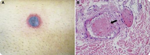 A 20-year-old white female was diagnosed with acute myelogenous leukemia. She underwent standard induction treatment: 7 days of cytarabine and 3 days of daunorubicin (7+3) chemotherapy. She developed neutropenic fever on the eighth day of induction and was started on broad-spectrum antibiotics. On day 10, when she was severely neutropenic, she developed a 0.5 × 0.5 cm nodule on the shin of her left leg, which rapidly developed into a large nodule with central darkening with pruritus (panel A). Over the next 24 hours, she developed a diffuse rash on her extremities, abdomen, and torso. She developed an altered mental status and was found to have left thalamus, cerebellar, and left posterior parietal lobe hyperintense lesions. The skin rash was biopsied, and the biopsy revealed angioinvasive fungus in the dermis with morphology most consistent with Fusarium (panel B, black arrow showing angioinvasive fungus). Her blood cultures later came back positive for Fusarium species. She was started on amphotericin but developed obstructive hydrocephalus and ultimately died as a result of cerebral hemorrhage on day 13 of induction therapy. No apparent source of disseminated Fusarium was identified. Her prolonged and persistent neutropenia from initial presentation to postinduction treatment put her at high risk for fungemia early in the course of treatment and increased her risk of death. / Disseminated fusariosis has a poor prognosis during induction chemotherapy for acute myeloid leukemia.