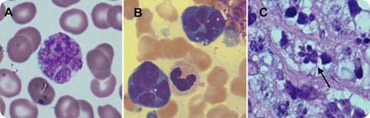 A 76-year-old man presented with right shoulder pain, weight loss, and night sweats. Complete blood count showed isolated thrombocytopenia (26 × 109/L). The blood film demonstrated medium to large atypical lymphoid cells (12% of leukocytes), many with polylobated nuclei or flower cell morphology (panel A, image obtained using Olympus BX51 microscope, ×1000 magnification). Computerized tomography identified a right scapular mass and retroperitoneal lymphadenopathy. Bone marrow examination (panel B) and biopsy of the scapular mass (panel C) revealed infiltration with atypical lymphoid cells identical to those in peripheral blood. These cells expressed CD20 and cytoplasmic immunoglobulin M (IgM) and were negative for surface immunoglobulin, CD3, and CD34 on flow cytometry. Terminal deoxynucleotidyltransferase and c-myc were negative on immunohistochemistry. Ki-67 was 40%. Cytogenetics identified an abnormal karyotype: 47, XY, t(1;6)(q32;q21), t(3;14)(q27;q32), +der(3)t(3:14). Fluorescence in situ hybridization confirmed B-cell lymphoma 6/IgH fusion at t(3;14). These features were consistent with diffuse large B-cell lymphoma in leukemic phase with flower cell morphology. / The World Health Organization classification of non-Hodgkin lymphomas recognizes morphologic variants of diffuse large B-cell lymphoma; however, even within this framework, the flower cell morphology seen in our case is rare. Although flower cells are typically associated with adult T-cell leukemia/lymphoma, in our case the cells are clearly of B-cell lineage. This demonstrates the importance of immunophenotyping in the classification of atypical mononuclear cells and that flower cell morphology is not confined to adult T-cell leukemia/lymphoma but can also be seen in diffuse large B-cell lymphoma.