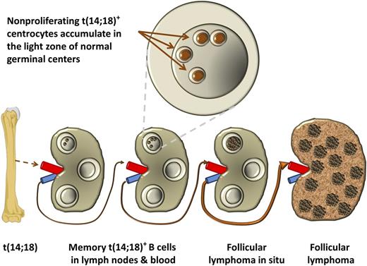 Tellier et al1 propose that the rare naïve t(14;18)-positive B cells as produced from erroneous VDJ recombinations in bone marrow precursor B cells may preferentially home germinal centers of lymph nodes where they reside as nonproliferating cells. Several rounds of reentry in this compartment in which the cells accumulate DNA damage may lead to functionally important gene mutations and consequently to the development of a so-called follicular lymphoma in situ and ultimately to overt follicular lymphoma.