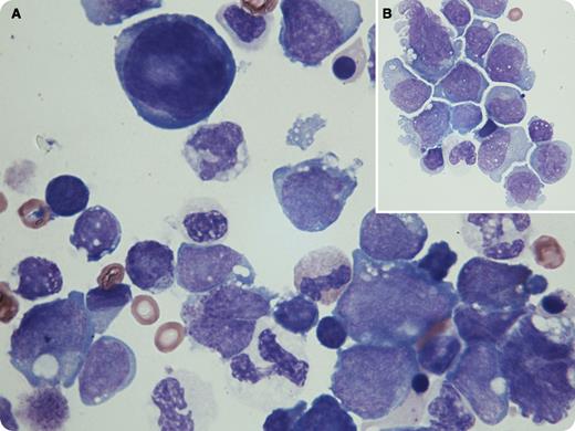 A 64-year-old female presented with poorly differentiated acute myeloid leukemia (AML) following a history of essential thrombocythemia. Bone marrow showed hypercellularity and 21% blasts, which were CD13+, CD33+, CD34+, CD45dim, MPO+, CD117+, and HLADR+. Cytogenetic testing revealed a complex karyotype; del(5q) and del(7q) were identified by fluorescence in situ hybridization. Blasts were seen on peripheral smear review. After failed induction with arabinosylcytosine and daunorubicin, treatment was replaced with decitabine and ruxolitinib. Complications included (presumed) fungal pneumonia, pleural and pericardial effusions, Staphylococcus bacteremia, pathological fracture of right coracoid process, and widespread osteolytic lesions. The patient reported fevers, night sweats, mild cough, and exertional dyspnea. Thoracentesis was performed, and the following cell counts were obtained: white blood cells, 1450/μL; red blood cells, 330/μL; and differential, 64% blasts with immunophenotype consistent with the initial diagnosis. As shown in panels A and B, blasts were pleomorphic with medium to giant/irregular forms, variable N:C ratio, basophilic cytoplasm, conspicuous nucleoli, smooth chromatin (moderate clumping in some), and occasional multinucleated form. Few blasts had sparse azurophilic granules, and a large atypical hyperchromatic mesothelial cell was also noted on the slide (panel A, top center). / Cytospin-induced changes in blast morphology include irregular nuclear contours, more pronounced nucleoli, increased cytoplasm, and abnormal concentration of cytoplasmic granules. Cytospin smears should be evaluated with caution in light of these in vitro preparation–induced changes.