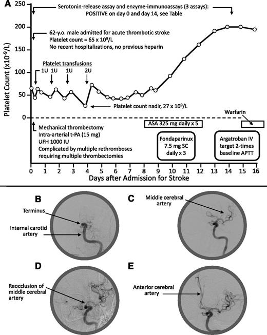 Figure 1. Patient 1: Clinical and radiological features. (A) Clinical course. (B) Thrombotic occlusion at internal carotid artery terminus. (C) Flow reestablished to MCA. (D) Reocclusion at origin of MCA (note: the unusual problem of 5 rapid rethromboses may have been related to heparin administration during the mechanical thrombectomies). (E) Flow reestablished to MCA and anterior cerebral artery (after infusion of tissue-plasminogen activator). No heparin exposure occurred as a result of the platelet transfusions (platelets were prepared using citrate anticoagulant). APTT, activated partial thromboplastin time; ASA, acetylsalicylic acid (aspirin); IU, international units; IV, intravenous; SC, subcutaneous; t-PA, tissue plasminogen activator; U, units; UFH, unfractionated heparin.